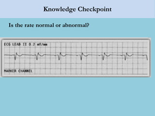 Knowledge Checkpoint
Is the rate normal or abnormal?
 
