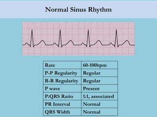 Normal Sinus Rhythm
Rate 60-100bpm
P-P Regularity Regular
R-R Regularity Regular
P wave Present
P:QRS Ratio 1:1, associated
PR Interval Normal
QRS Width Normal
 
