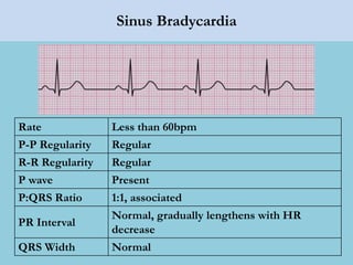 Sinus Bradycardia
Rate Less than 60bpm
P-P Regularity Regular
R-R Regularity Regular
P wave Present
P:QRS Ratio 1:1, associated
PR Interval
Normal, gradually lengthens with HR
decrease
QRS Width Normal
 