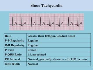 Sinus Tachycardia
Rate Greater than 100bpm, Gradual onset
P-P Regularity Regular
R-R Regularity Regular
P wave Present
P:QRS Ratio 1:1, associated
PR Interval Normal, gradually shortens with HR increase
QRS Width Normal
 