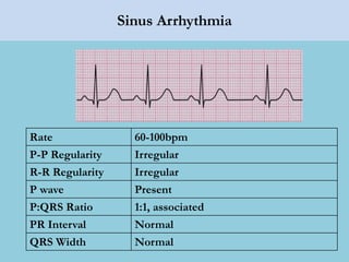 Sinus Arrhythmia
Rate 60-100bpm
P-P Regularity Irregular
R-R Regularity Irregular
P wave Present
P:QRS Ratio 1:1, associated
PR Interval Normal
QRS Width Normal
 