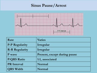 Sinus Pause/Arrest
Rate Varies
P-P Regularity Irregular
R-R Regularity Irregular
P wave Present, except during pause
P:QRS Ratio 1:1, associated
PR Interval Normal
QRS Width Normal
 