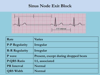 Sinus Node Exit Block
Rate Varies
P-P Regularity Irregular
R-R Regularity Irregular
P wave Present, except during dropped beats
P:QRS Ratio 1:1, associated
PR Interval Normal
QRS Width Normal
 
