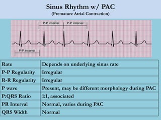 Sinus Rhythm w/ PAC
(Premature Atrial Contraction)
Rate Depends on underlying sinus rate
P-P Regularity Irregular
R-R Regularity Irregular
P wave Present, may be different morphology during PAC
P:QRS Ratio 1:1, associated
PR Interval Normal, varies during PAC
QRS Width Normal
 