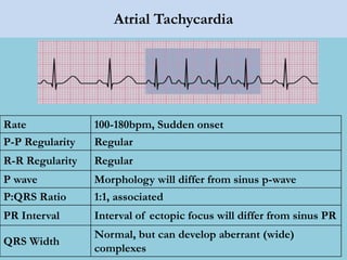 Atrial Tachycardia
Rate 100-180bpm, Sudden onset
P-P Regularity Regular
R-R Regularity Regular
P wave Morphology will differ from sinus p-wave
P:QRS Ratio 1:1, associated
PR Interval Interval of ectopic focus will differ from sinus PR
QRS Width
Normal, but can develop aberrant (wide)
complexes
 