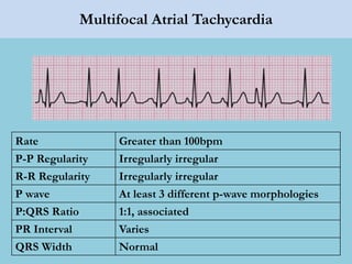 Multifocal Atrial Tachycardia
Rate Greater than 100bpm
P-P Regularity Irregularly irregular
R-R Regularity Irregularly irregular
P wave At least 3 different p-wave morphologies
P:QRS Ratio 1:1, associated
PR Interval Varies
QRS Width Normal
 