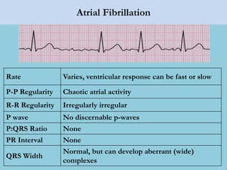 Atrial Fibrillation
Rate Varies, ventricular response can be fast or slow
P-P Regularity Chaotic atrial activity
R-R Regularity Irregularly irregular
P wave No discernable p-waves
P:QRS Ratio None
PR Interval None
QRS Width
Normal, but can develop aberrant (wide)
complexes
 