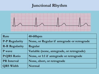 Junctional Rhythm
Rate 40-60bpm
P-P Regularity None, or Regular if antegrade or retrograde
R-R Regularity Regular
P wave Variable (none, antegrade, or retrograde)
P:QRS Ratio None, or 1:1 if antegrade or retrograde
PR Interval None, short, or retrograde
QRS Width Normal
 
