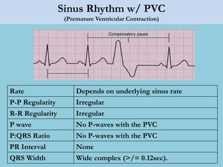 Sinus Rhythm w/ PVC
(Premature Ventricular Contraction)
Rate Depends on underlying sinus rate
P-P Regularity Irregular
R-R Regularity Irregular
P wave No P-waves with the PVC
P:QRS Ratio No P-waves with the PVC
PR Interval None
QRS Width Wide complex (>/= 0.12sec).
 