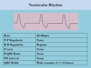 Ventricular Rhythm
Rate 20-40bpm
P-P Regularity None
R-R Regularity Regular
P wave None
P:QRS Ratio None
PR Interval None
QRS Width Wide complex (>/= 0.12sec).
 