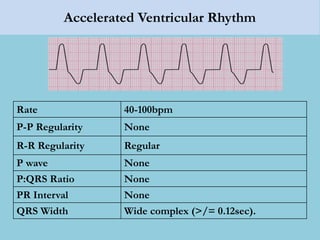 Accelerated Ventricular Rhythm
Rate 40-100bpm
P-P Regularity None
R-R Regularity Regular
P wave None
P:QRS Ratio None
PR Interval None
QRS Width Wide complex (>/= 0.12sec).
 