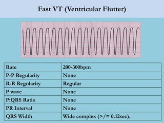 Fast VT (Ventricular Flutter)
Rate 200-300bpm
P-P Regularity None
R-R Regularity Regular
P wave None
P:QRS Ratio None
PR Interval None
QRS Width Wide complex (>/= 0.12sec).
 
