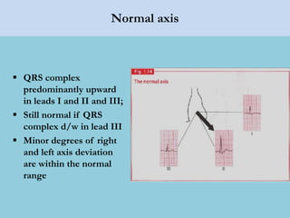 Normal axis
 QRS complex
predominantly upward
in leads I and II and III;
 Still normal if QRS
complex d/w in lead III
 Minor degrees of right
and left axis deviation
are within the normal
range
 