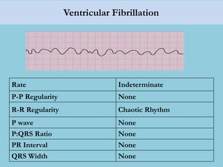 Ventricular Fibrillation
Rate Indeterminate
P-P Regularity None
R-R Regularity Chaotic Rhythm
P wave None
P:QRS Ratio None
PR Interval None
QRS Width None
 