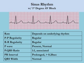 Sinus Rhythm
w/ 1st Degree AV Block
Rate Depends on underlying rhythm
P-P Regularity Regular
R-R Regularity Regular
P wave Present, Normal
P:QRS Ratio 1:1, associated
PR Interval Prolonged, > 0.20sec
QRS Width Normal
 