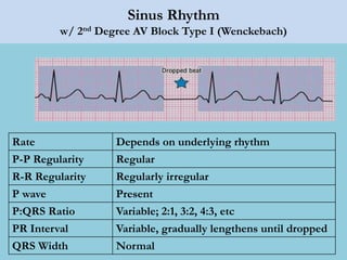 Sinus Rhythm
w/ 2nd Degree AV Block Type I (Wenckebach)
Rate Depends on underlying rhythm
P-P Regularity Regular
R-R Regularity Regularly irregular
P wave Present
P:QRS Ratio Variable; 2:1, 3:2, 4:3, etc
PR Interval Variable, gradually lengthens until dropped
QRS Width Normal
 