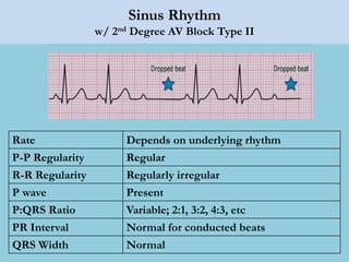 Sinus Rhythm
w/ 2nd Degree AV Block Type II
Rate Depends on underlying rhythm
P-P Regularity Regular
R-R Regularity Regularly irregular
P wave Present
P:QRS Ratio Variable; 2:1, 3:2, 4:3, etc
PR Interval Normal for conducted beats
QRS Width Normal
 
