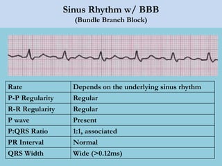 Sinus Rhythm w/ BBB
(Bundle Branch Block)
Rate Depends on the underlying sinus rhythm
P-P Regularity Regular
R-R Regularity Regular
P wave Present
P:QRS Ratio 1:1, associated
PR Interval Normal
QRS Width Wide (>0.12ms)
 