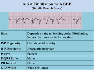 Atrial Fibrillation with BBB
(Bundle Branch Block)
Rate Depends on the underlying Atrial Fibrillation,
Ventricular rate can be fast or slow.
P-P Regularity Chaotic atrial activity
R-R Regularity Irregularly irregular
P wave Present
P:QRS Ratio None
PR Interval None
QRS Width Wide (>0.12ms)
 