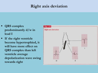 Right axis deviation
 QRS complex
predominantly d/w in
lead I
 If the right ventricle
become hypertrophied, it
will have more effect on
QRS complex than left
ventricle average
depolarization wave swing
towards right
 