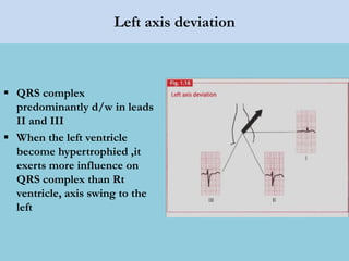 Left axis deviation
 QRS complex
predominantly d/w in leads
II and III
 When the left ventricle
become hypertrophied ,it
exerts more influence on
QRS complex than Rt
ventricle, axis swing to the
left
 