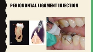PERIODONTAL LIGAMENT INJECTION
 