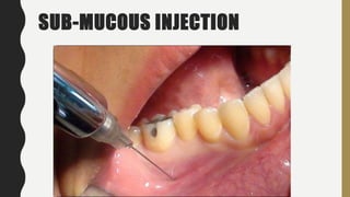 SUB-MUCOUS INJECTION
 