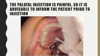 THE PALATAL INJECTION IS PAINFUL, SO IT IS
ADVISABLE TO INFORM THE PATIENT PRIOR TO
INJECTION
 