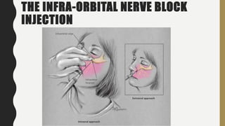 THE INFRA-ORBITAL NERVE BLOCK
INJECTION
 