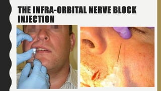 THE INFRA-ORBITAL NERVE BLOCK
INJECTION
 