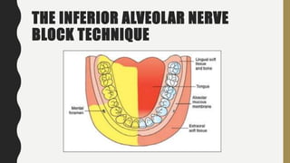 THE INFERIOR ALVEOLAR NERVE
BLOCK TECHNIQUE
 