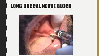 LONG BUCCAL NERVE BLOCK
 
