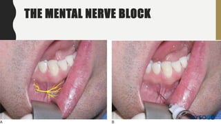 THE MENTAL NERVE BLOCK
 