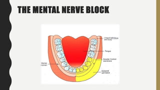 THE MENTAL NERVE BLOCK
 
