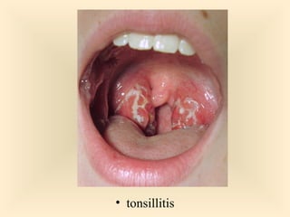  tonsillitis

34

 
