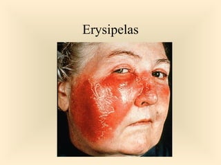 Erysipelas

37

 
