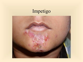 Impetigo

38

 