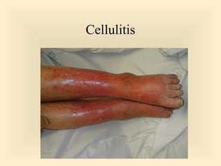 Cellulitis

40

 
