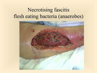 Necrotising fascitis
flesh eating bacteria (anaerobes)

41

 