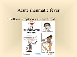 Acute rheumatic fever
 Follows streptococcal sore throat

43

 