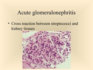 Acute glomerulonephritis
 Cross reaction between streptococci and

kidney tissues

44

 