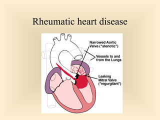 Rheumatic heart disease

45

 
