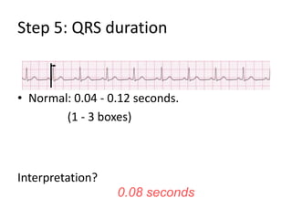 Step 5: QRS durationNormal: 0.04 - 0.12 seconds.                 (1 - 3 boxes)Interpretation?0.08 seconds