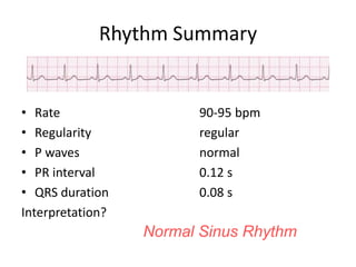 Rhythm SummaryRate				90-95 bpm	Regularity				regularP waves				normalPR interval			0.12 sQRS duration			0.08 sInterpretation?Normal Sinus Rhythm