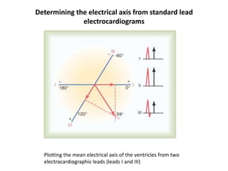 Determining the electrical axis from standard lead electrocardiogramsPlotting the mean electrical axis of the ventricles from two electrocardiographic leads (leads I and III)