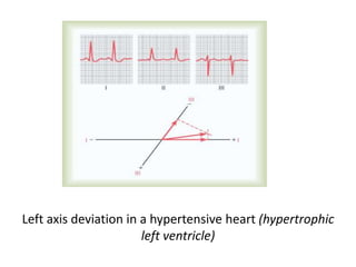 Left axis deviation in a hypertensive heart (hypertrophic left ventricle)