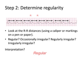 Step 2: Determine regularityLook at the R-R distances (using a caliper or markings on a pen or paper).Regular? Occasionally irregular? Regularly irregular? Irregularly irregular?Interpretation?RRRegular