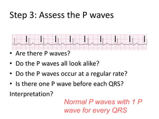 Step 3: Assess the P wavesAre there P waves?Do the P waves all look alike?Do the P waves occur at a regular rate?Is there one P wave before each QRS?Interpretation?Normal P waves with 1 P wave for every QRS