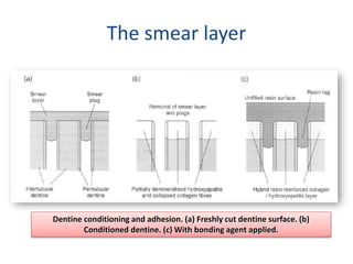 Smearing Adhesion Example lec 1 Bonding to Dental Substrates or Adhesion.pptx