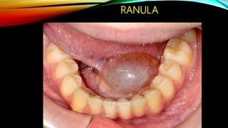 Lec 1 cysts of orofacial region | PPTX